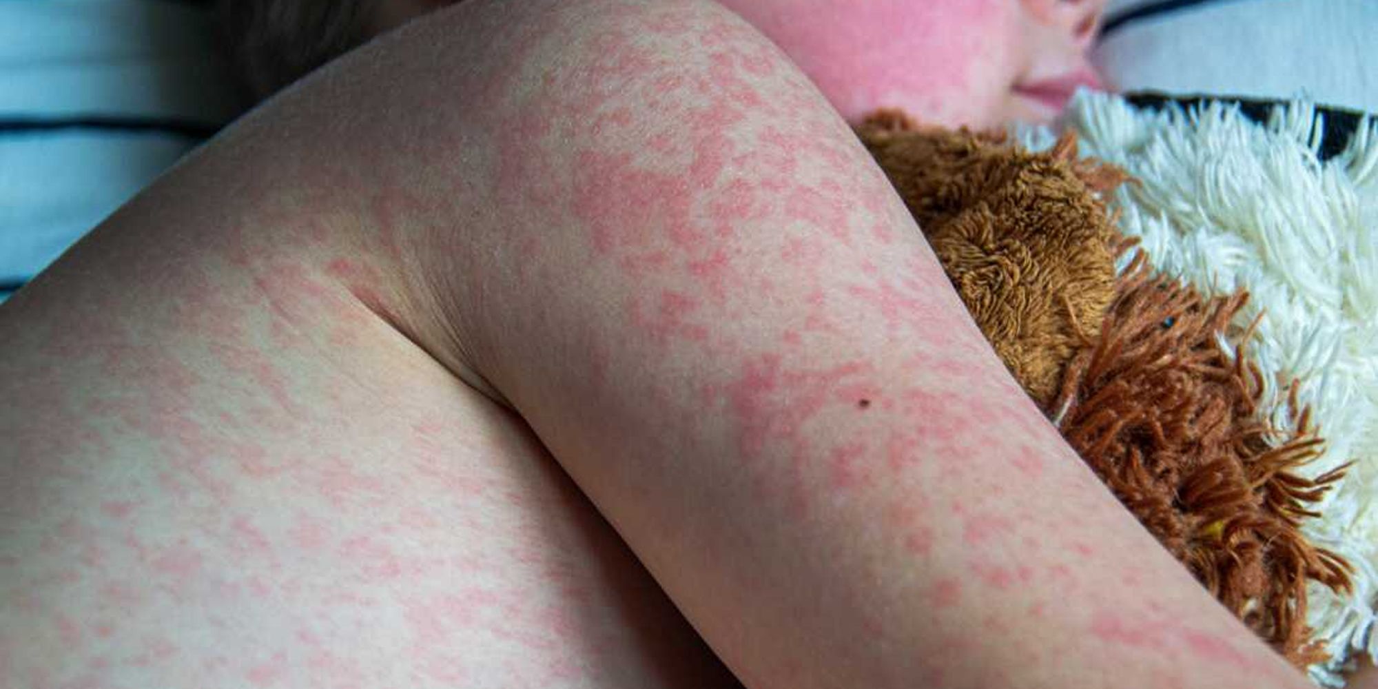 Measles Outbreak Spreads Across Western Texas, Raising Urgent Vaccination Concerns